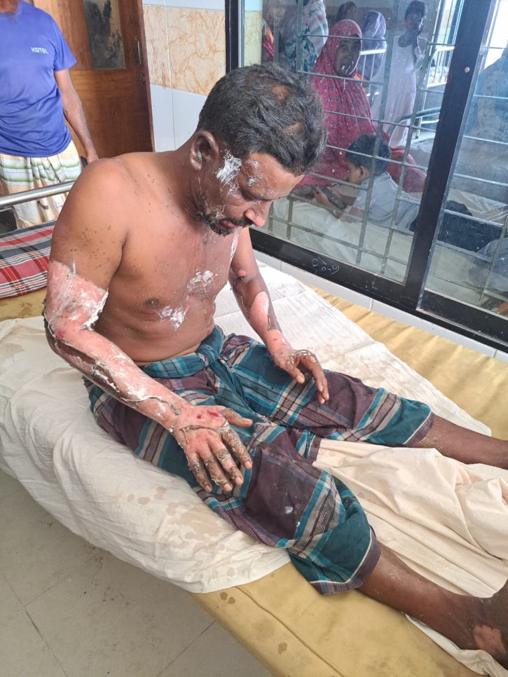 নওগাঁয় মাদক মামলায় সাক্ষী হওয়ায় যুবককে পেট্রোল ঢেলে পুড়িয়ে হত্যার চেষ্টা
